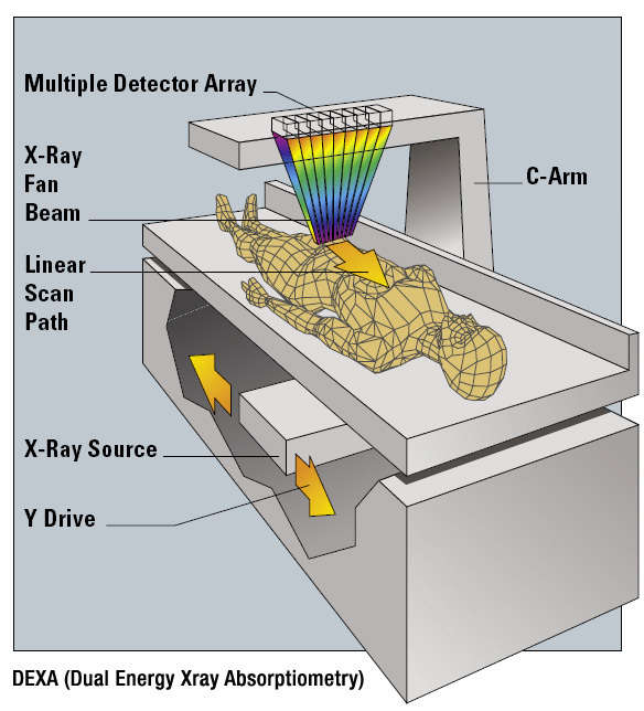 dual-energy X-ray absorptiometry
