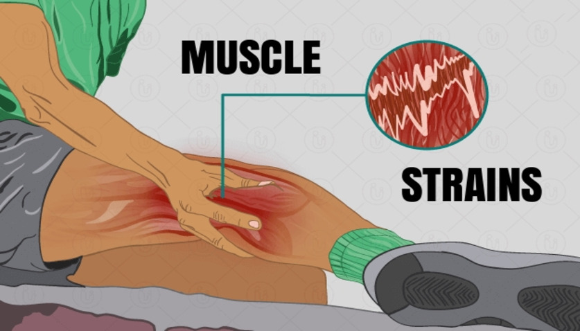 Muscle Strains: Symptoms, Causes, and Treatment • Bodybuilding Wizard