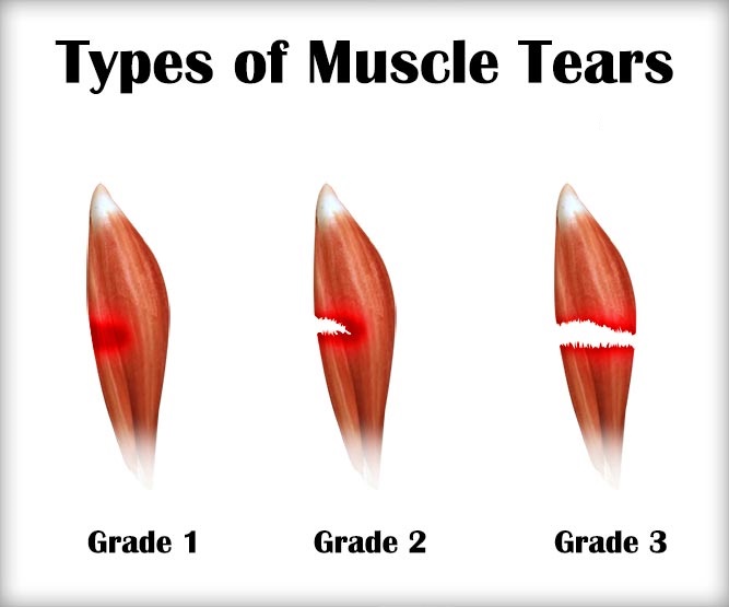 muscle tears classification