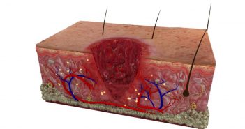 Stages Of Soft Tissue Healing stages of soft tissue healing